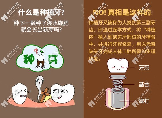 在廣州好大夫口腔做進口種植牙多少錢,缺牙久了還能種牙嗎