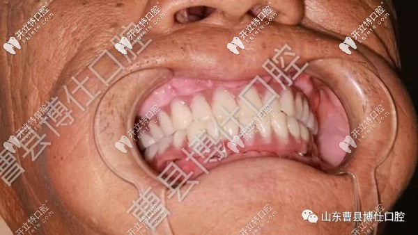 做完種植牙后的牙齒情況
