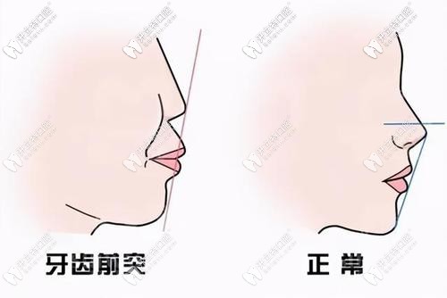 牙齒前突的來看看煙臺(tái)圣貝口腔矯正牙齒怎么樣