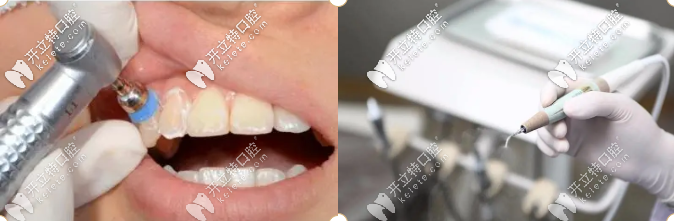 潔牙、牙修復(fù)等立減價(jià)格