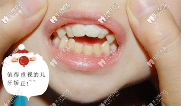 增城區(qū)兒童牙齒矯正參考價(jià)格