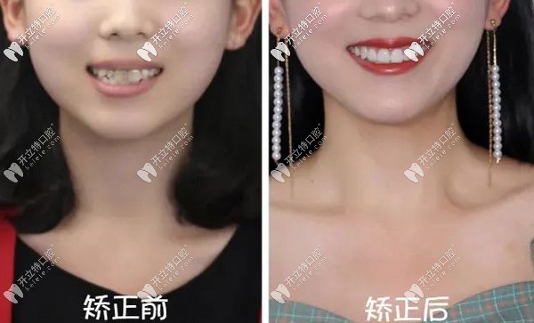 哇~22歲重度齙牙的我做了正雅日夜版隱形矯正竟然逆襲！