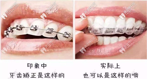 告別鋼牙妹，別錯(cuò)過隱形矯正哦