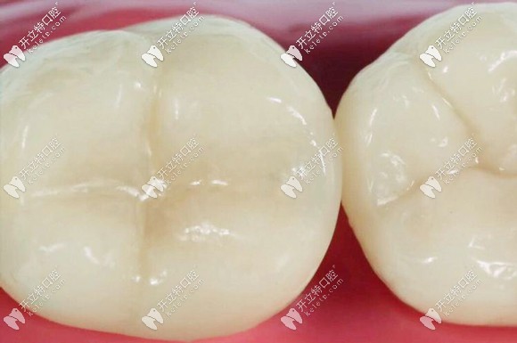 美學(xué)補(bǔ)牙修復(fù)后的效果圖 美學(xué)補(bǔ)牙修復(fù)后的效果圖