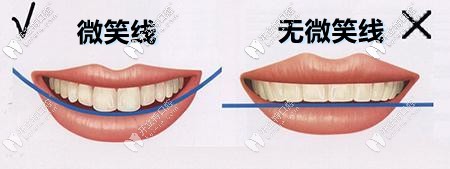 微笑線設(shè)計前后對比圖