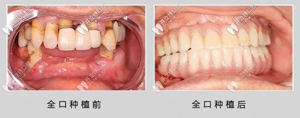69歲退伍老兵做了ALL- on-6全口種植牙，感言：再活30年！
