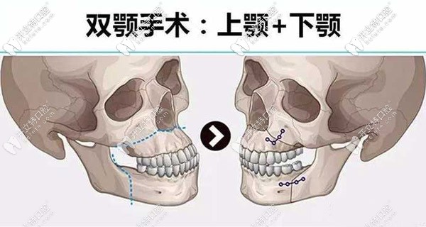 <!--<i data=20240703-sp></i>-->做骨性地包天矯正的費(fèi)用是多少？