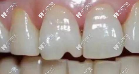 常吃堅(jiān)果會加速牙齒的磨耗，使牙齒出現(xiàn)裂紋
