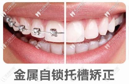 金屬自鎖托槽