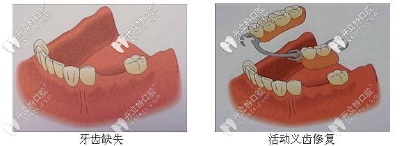 活動義齒修復(fù)后圖示