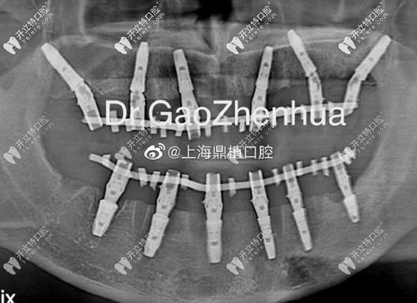 全口即刻負(fù)重即刻修復(fù)