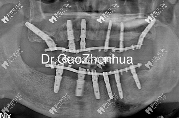 上頜VIIV、下頜6顆即刻種植方案