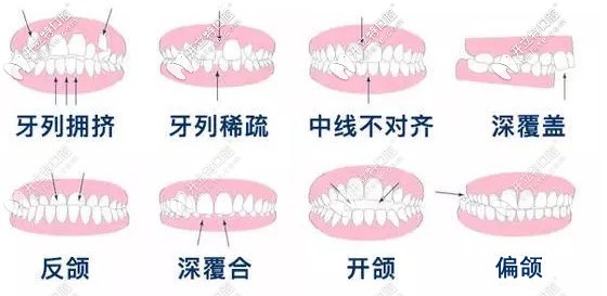  渭南牙科做牙齒矯正多少錢？想知道隱形和金屬矯正的價格