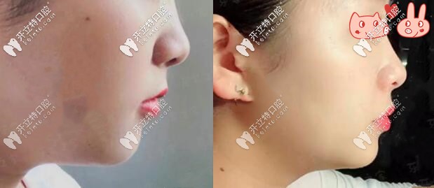 1年后側(cè)面對(duì)比圖，效果顯著