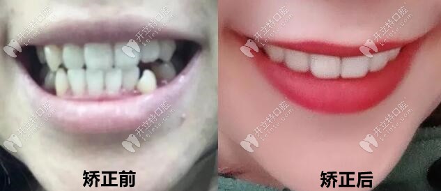 通過(guò)3年矯正變化，現(xiàn)在我的牙齒美美噠