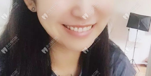 矯正后的效果