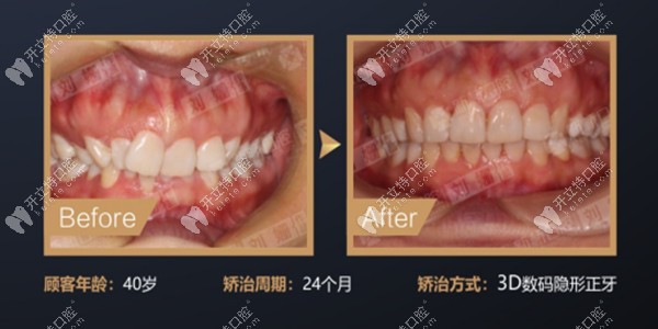 矯正前后牙齒變化