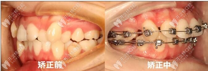 陳醫(yī)生牙齒擁擠戴自鎖托槽矯正案例