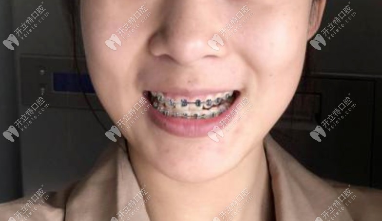 矯正剛帶上牙套一周的時間