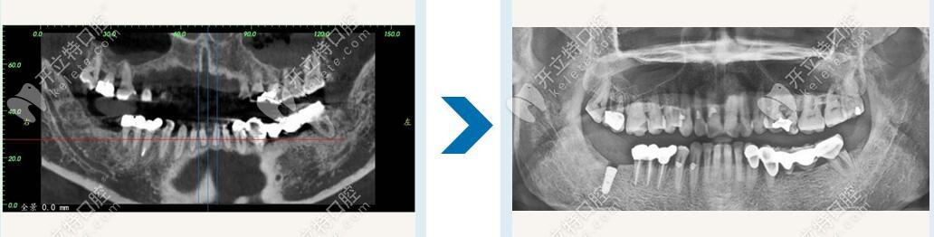 南寧柏樂口腔種植牙修復(fù)