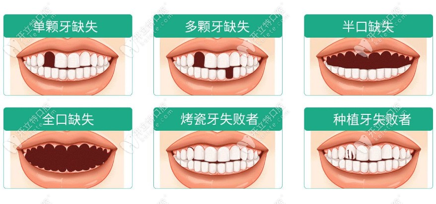 珠海九龍口腔韓國進(jìn)口種植牙適應(yīng)癥