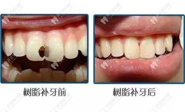 樹脂補牙前后效果對比