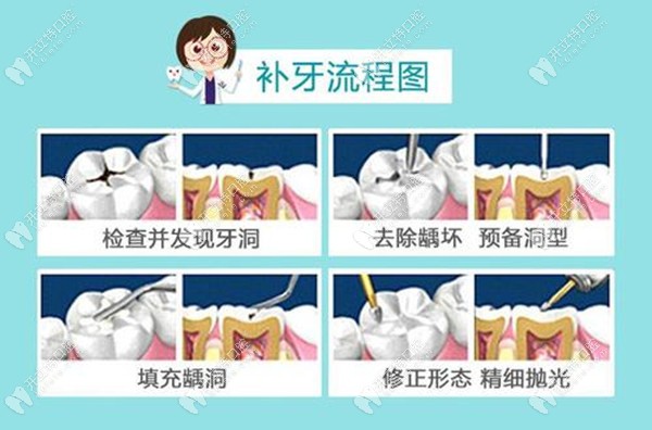 補牙過程圖解