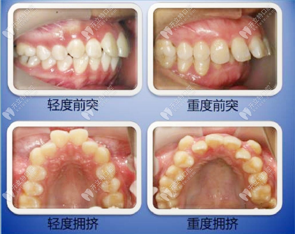 什么情況下需要拔牙才能矯正牙齒？