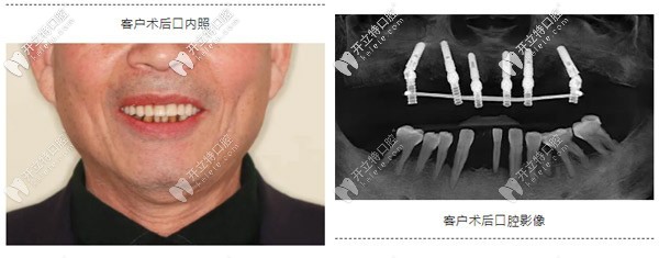 典型重度牙周炎種植案例:如何實現(xiàn)即刻種植與即刻修復？