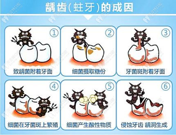跪求廈門補(bǔ)牙哪家醫(yī)院好，補(bǔ)蛀牙一般多少錢一顆