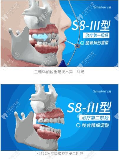 正雅S8、S9、S10頜位重建術(shù)