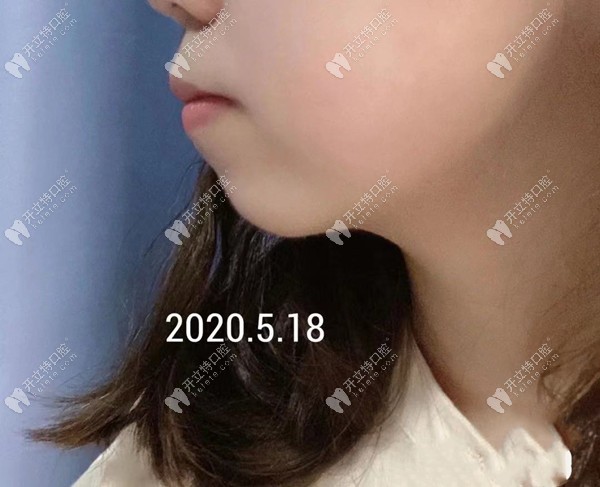 重慶華美口腔丁愛軍醫(yī)生矯正骨性齙牙嘴凸效果怎么樣？